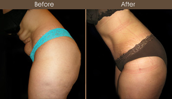 New York Tummy Tuck Surgery Before And After